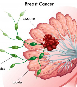prostate cancer analysis delhi Dr. Kundan Singh Chufal