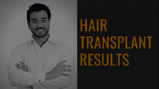 hair analysis delhi AK Clinics Hair Transplant Delhi - Best Hair Transplant Clinic