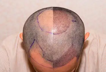 FUE Hair Transplant Clinic in Delhi and Gurgaon