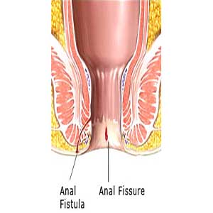 furuncle specialists delhi Dr. V. P. Singh Clinic (Since 1960) piles Fissure Fistula pilonidal sinus