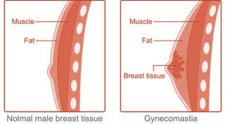 gynecomastia clinics in delhi Dr Amit Gupta - Best Gynecomastia | Hair Transplant |Breast Implant |Liposuction|Plastic Surgeon|Botox Fillers Mastertrainer in Delhi