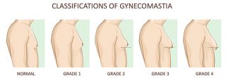 breast reduction clinics delhi Gynecomastia Clinic in Delhi | Best Male Breast Reduction Cost in India