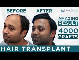 hair analysis delhi MedLinks Hair Transplant Delhi - Best Hair Transplant Clinic
