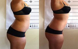 The combination of several body sculpting procedures to get toned and lean figure.