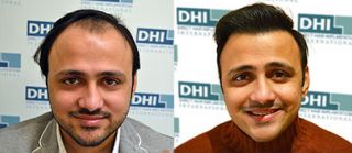 hair graft clinics in delhi DHI India - Best Hair Transplant Clinic in Delhi