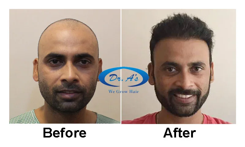 hair analysis delhi Dr. A's Clinic - Best Hair Transplant in Delhi