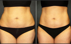 Liposuction, also known as fat removal surgery or fat reduction surgery.